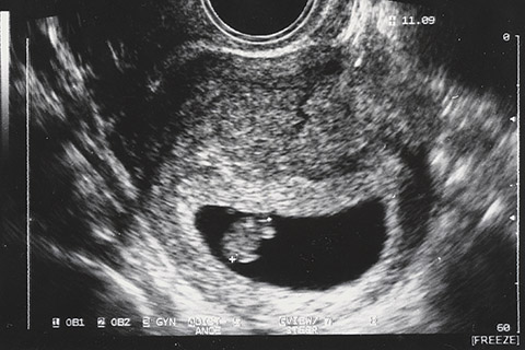 Ultrasound image of a 6-week fetus.