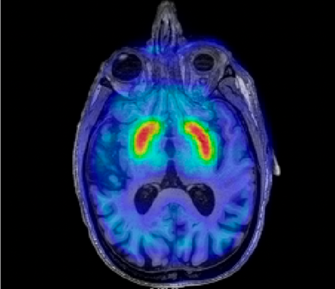 Dopamine scan